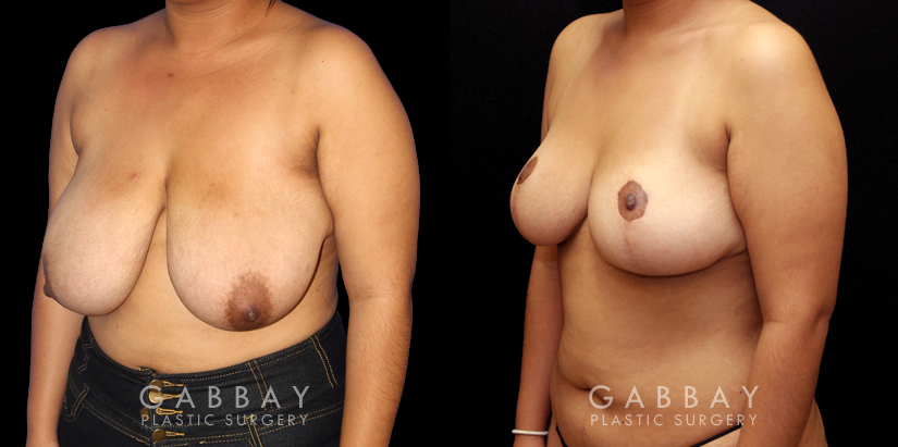 Patient 03 3/4th Left Side View Mastopexy Gabbay Plastic Surgery