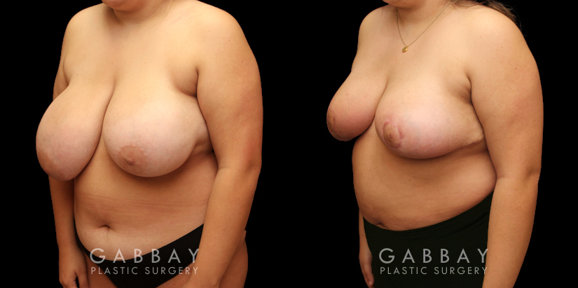 Patient 05 3/4th Left Side View Breast Reduction Gabbay Plastic Surgery