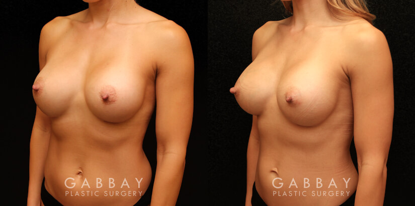 Patient 01 3/4th Left Side View Breast Revision Gabbay Plastic Surgery