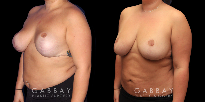 Patient 03 3/4th Left Side View Revision Breast Reduction, Revision Wide Mastopext, Belladerm Gabbay Plastic Surgery