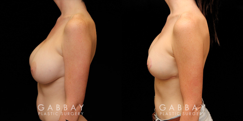 This patient had a previous breast augmentation with implants that she felt were far too big for her frame and not the look that she wanted. She had requested that her prior surgeon perform a breast lift because she had extreme breast droop or ptosis. Her surgeon chose to simply put in a large breast implant instead, and left her very unhappy. She came to Gabbay Plastic Surgery for a breast implant, revision and lift. Her implants were exchanged for smaller silicone implants, the pockets were closed into an appropriate size, and she underwent a breast lift to reduce the droop. Galaflex mesh was also used to keep her breasts lifted overtime. Over time, her scars almost completely disappeared, and she was extremely happy with her new look.