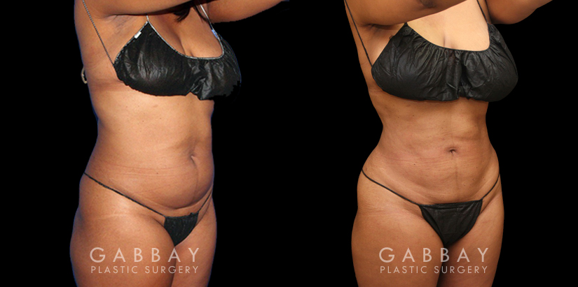 Female patient’s liposuction results, tightening her abdomen area significantly while minimizing any scarring. Patient recovered without complications and enjoyed an enhanced visibility of her natural curvy contours.