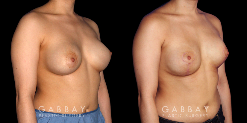 Patient 06 3/4th Right Side View Breast Augmentation-Remove and Replace Saline & Full Lift Gabbay Plastic Surgery