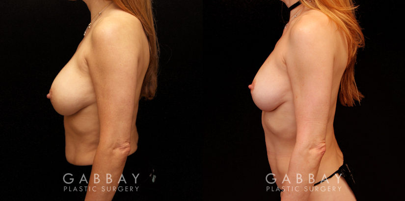 Patient 11 Left Side View Implant Removal and Lift Gabbay Plastic Surgery