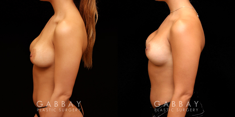 Patient 13 Left Side View Removal and Replacement of SIL Implants Capsulorrhaphy Gabbay Plastic Surgery