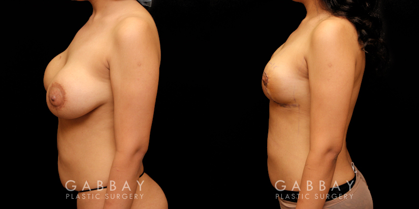 Patient 15 Left Side View Removal of Implants, Auto Augmentation with Mesh Gabbay Plastic Surgery