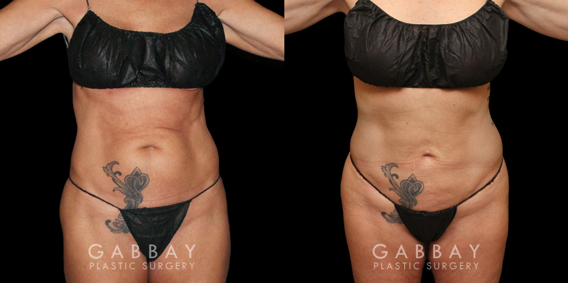 Liposuction before-and-after for female patient who wanted subtle fat removal around the lower abdomen to target stubborn belly fat. Her results show a decrease in lower abdominal bulge for a flatter contour.
