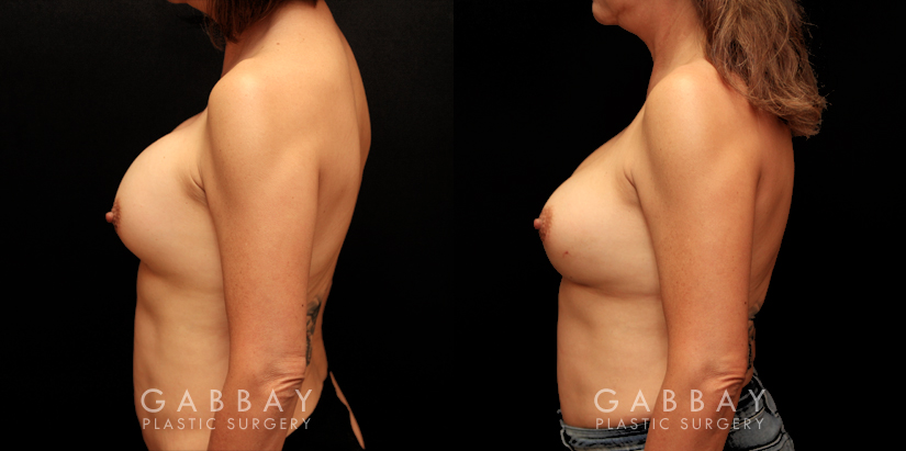 Patient 16 Left Side View Removal and Replacement Gabbay Plastic Surgery