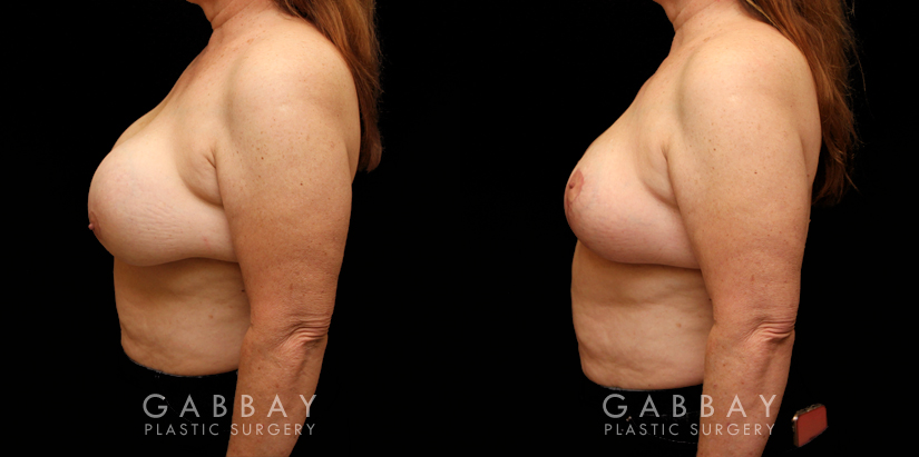 Patient 17 Left Side View Implant Removal and Lift Gabbay Plastic Surgery