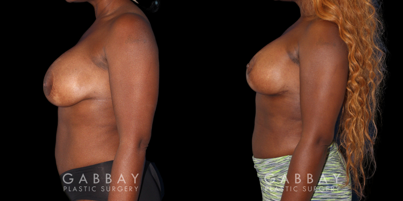 Patient 18 Left Side View Breast Revision Gabbay Plastic Surgery