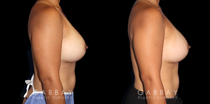 Patient 19 Right Side View Breast Revision Gabbay Plastic Surgery