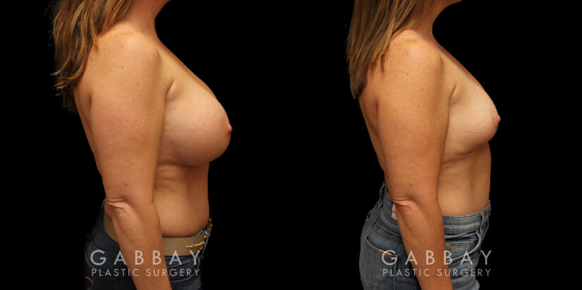 Patient 01 Right Side View Implant Removal with Aug/Pexy Gabbay Plastic Surgery