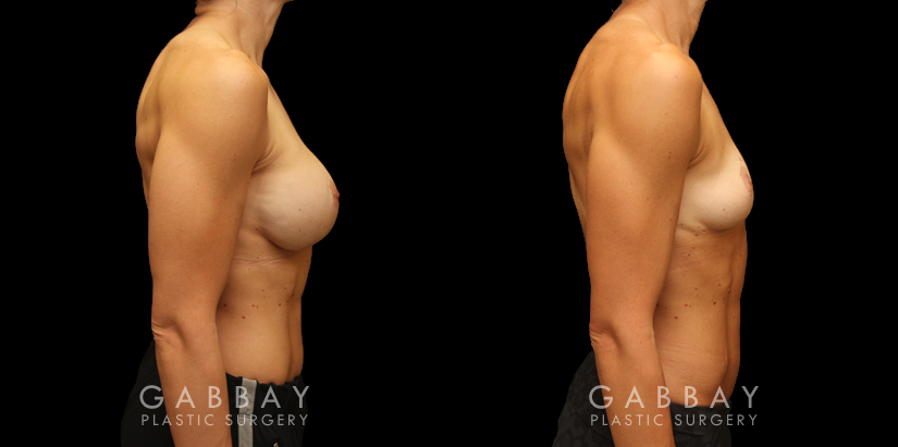 Patient 03 Right Side View Implant Removal/Mastopexy/Auto Augmentation Gabbay Plastic Surgery