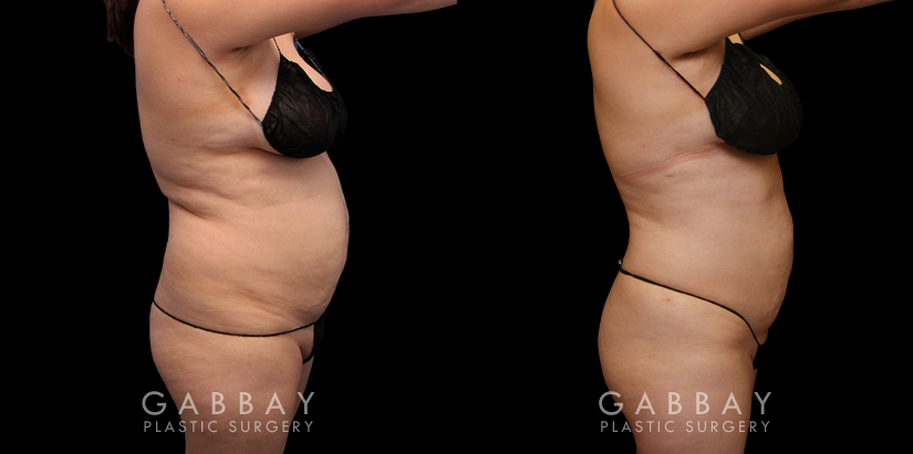Abdominal liposuction results for female patient who wanted to address stubborn belly fat that did not respond to diet and exercise. Results show reduced overall profile that also lends itself to her natural body shape and features.