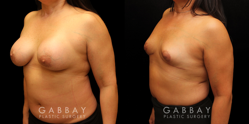 Patient 06 3/4th Left Side View Auto Augmentation with Lift Gabbay Plastic Surgery