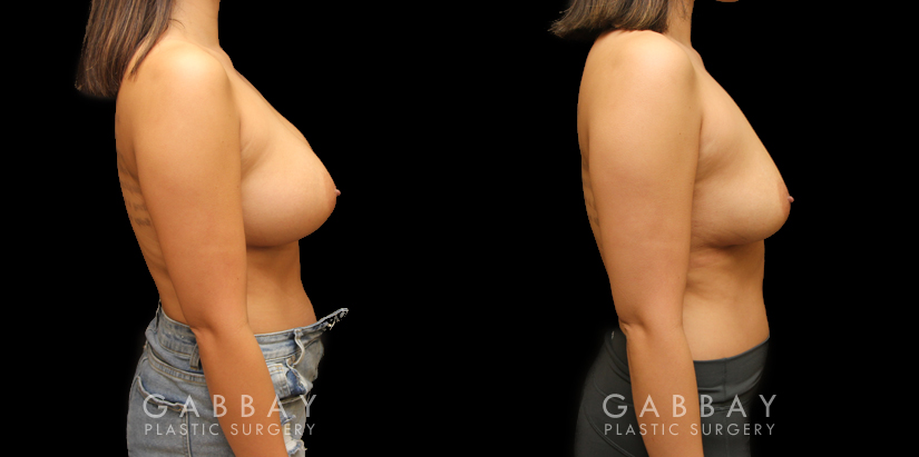 Patient 08 Right Side View Implant Removal and Lift Gabbay Plastic Surgery