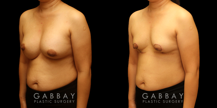 Patient 09 3/4th Left Side View Breast Implant Removal and Lift Gabbay Plastic Surgery