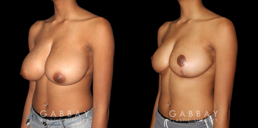 Patient 02 3/4th Left Side View Breast Reduction Gabbay Plastic Surgery