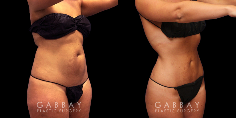 Female patient showing results of her 360 liposuction with a focus on the abdominal area. Patient’s natural figure was enhanced, showing slimmer waist, flattened stomach, and tightened skin.