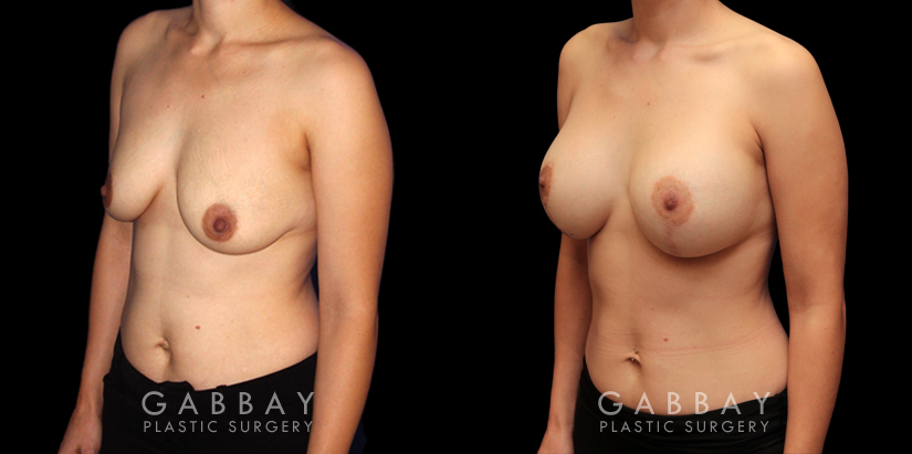 Patient 08 3/4th Left Side View Scar Revision to Breasts Gabbay Plastic Surgery