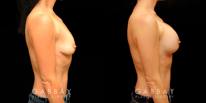Patient 12 Right Side View Breast Augmentation with Areola Lift Gabbay Plastic Surgery