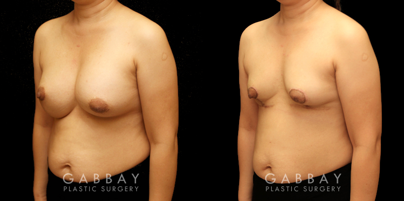 Patient 13 3/4th Left Side View Breast Implant Removal and Lift Gabbay Plastic Surgery
