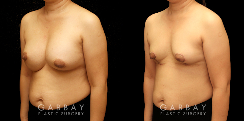 Breast implant removal and lift