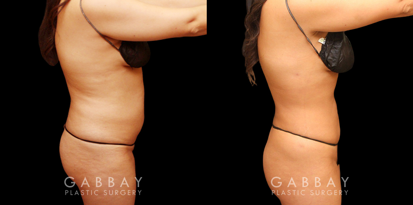 Female liposuction results with significant fat reduction in the abdomen for a tighter appearance while maintaining a natural-looking body contour. Patient recovered quickly and without complications.