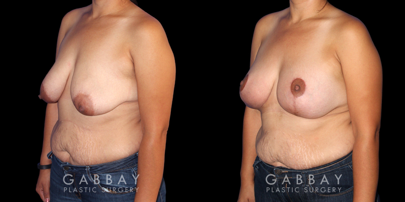 Patient 18 3/4th Left Side View Breast Augmentation Silicone, Mastopexy Gabbay Plastic Surgery