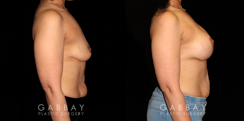 Patient 20 Right Side View Breast Augmentation Silicone & Lift Gabbay Plastic Surgery
