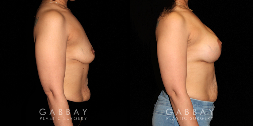 Breast Augmentation – Silicone & Lift