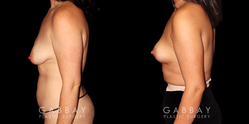 Patient 21 Left Side View Mastopexy and Liposuction Gabbay Plastic Surgery