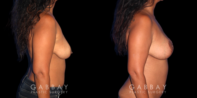 Patient 25 Right Side View Wise Mastopexy with Silicone Breast Implants Gabbay Plastic Surgery