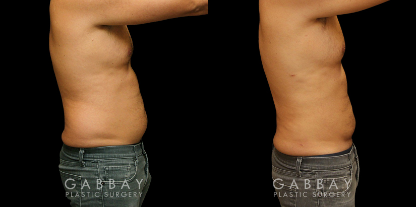 Male liposuction results after reducing stubborn belly fat that would not respond to diet or exercise. The belly area went from significant overhang above the beltline to a flatter contour.