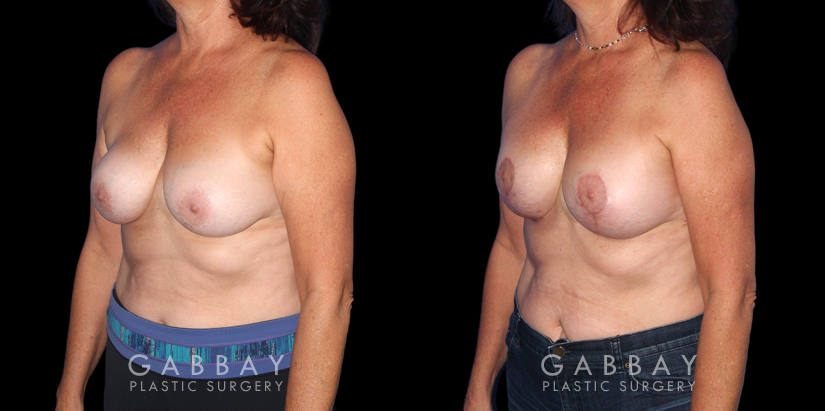 Patient 26 3/4th Left Side View R&R Breast Lift Gabbay Plastic Surgery