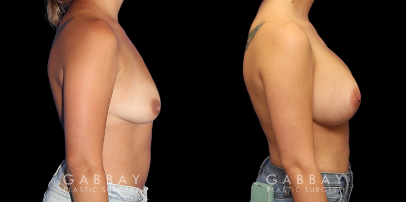 Breast Augmentation w/ Mastopexy – Silicone