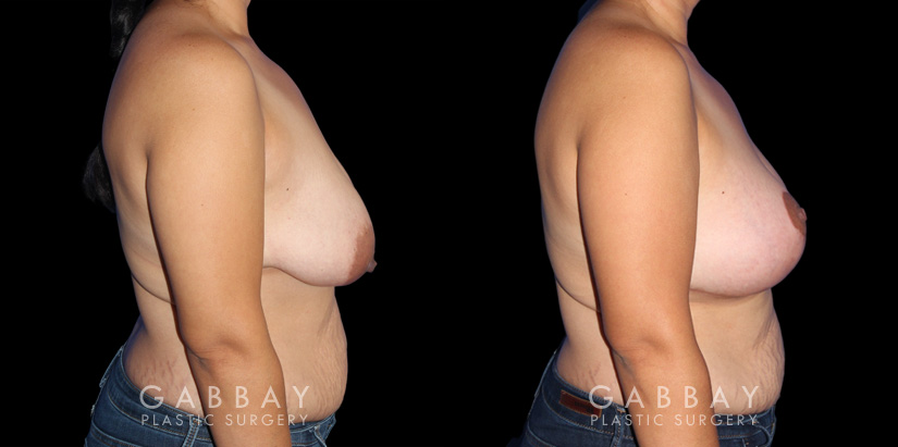 Breast Augmentation – Silicone, Mastopexy