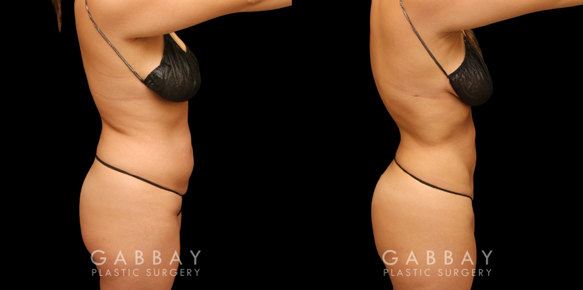 Female abdominal fat removal results showcasing a patient's flatter tummy area, with no side effects from the liposuction procedure. The fat removed is permanently gone, with straightforward maintenance of results.