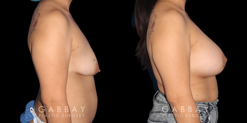 Patient 15 Right Side View Breast Augmentation - Silicone & Lift Gabbay Plastic Surgery