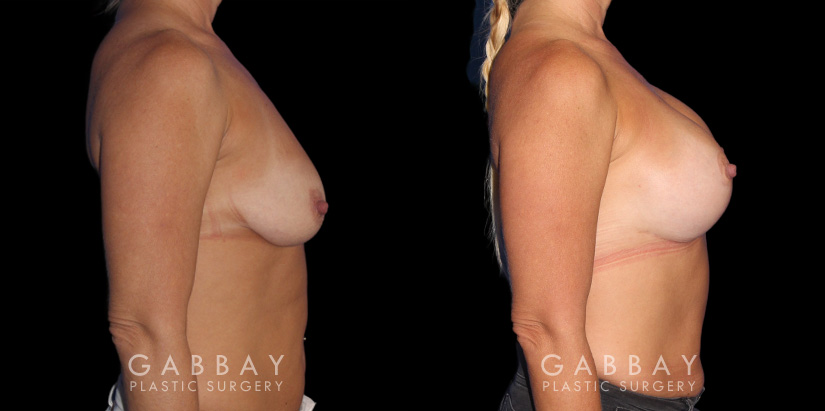 Wise Mastopexy with Silicone Breast Implants