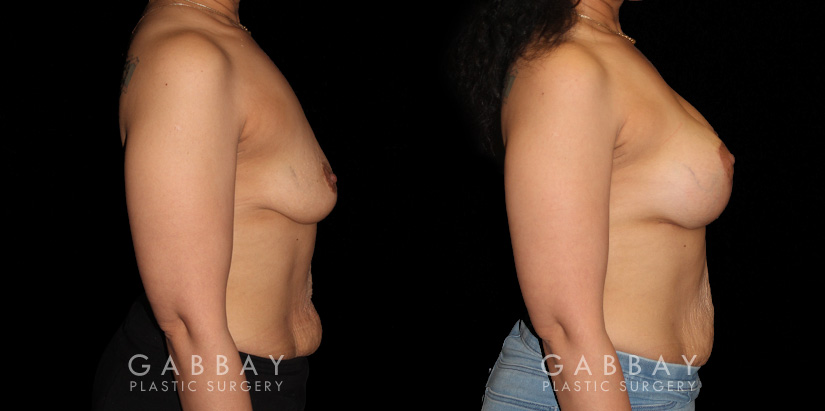 Patient 18 Right Side View Breast Augmentation - Silicone & Lift Gabbay Plastic Surgery