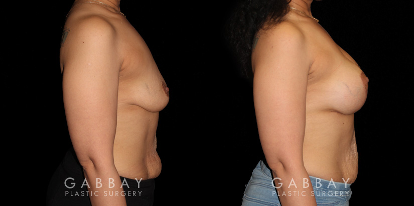 Breast Augmentation – Silicone & Lift