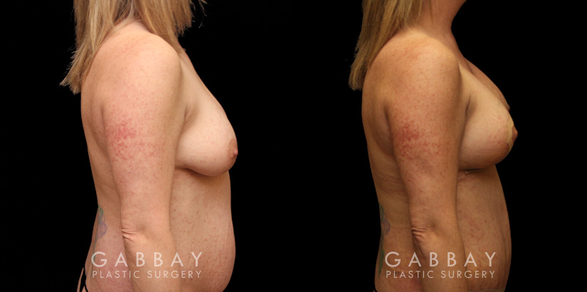 Patient 20 Right Side View Breast aug/pexy and tummy tuck Gabbay Plastic Surgery