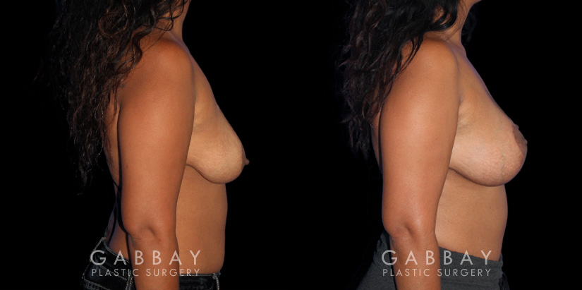 Patient 21 Right Side View Wise Mastopexy with Silicone Breast Implants Gabbay Plastic Surgery