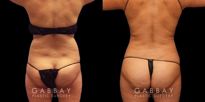 Results of a safe abdominal liposuction surgery that provided this female patient with notable slimming. Note the flat stomach from the profile view with no overhang above the waistline.
