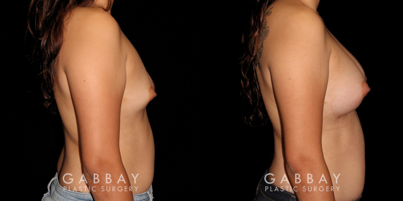Patient 13 Right Side View Augpexy Gabbay Plastic Surgery