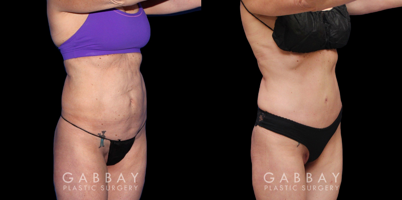 Before and after photos for body procedures, including a tummy tuck and inner thigh liposuction. Combining the procedures resulted in a flatter, smoother abdomen balanced with subtle yet effective tightening of the thighs. The final result evokes a more youthful contour.