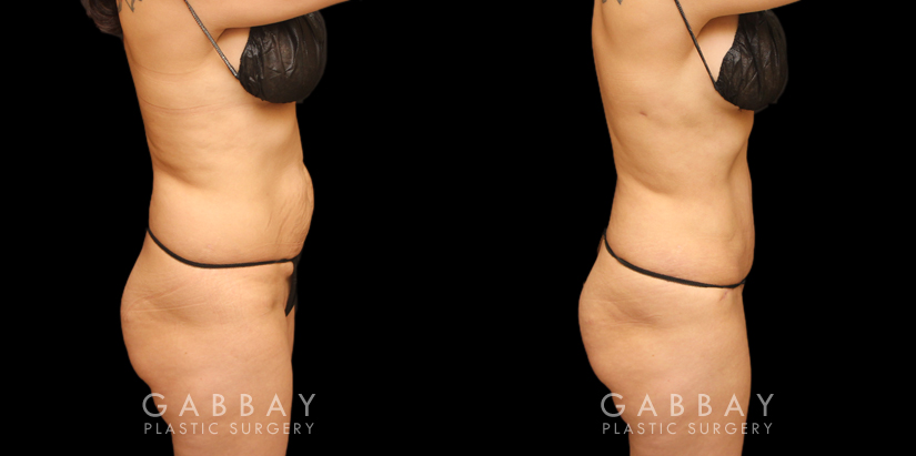 Before and after combined tummy tuck and liposuction of the abdomen, back bra roll, and waist. This 360-degree approach resulting in a balanced outcome, slimmed profile, and fitter looking contour. The patient recovered smoothly from the multi-procedure surgery and healed on schedule.