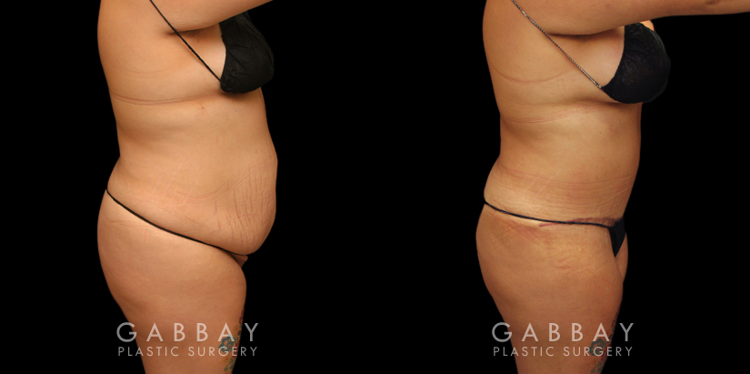 Tummy tuck before and after photos, along with combined liposuction, breast lift, and breast augmentation. Abdominal tightening enhanced the increase in breast volume for a curvier, fitter aesthetic.