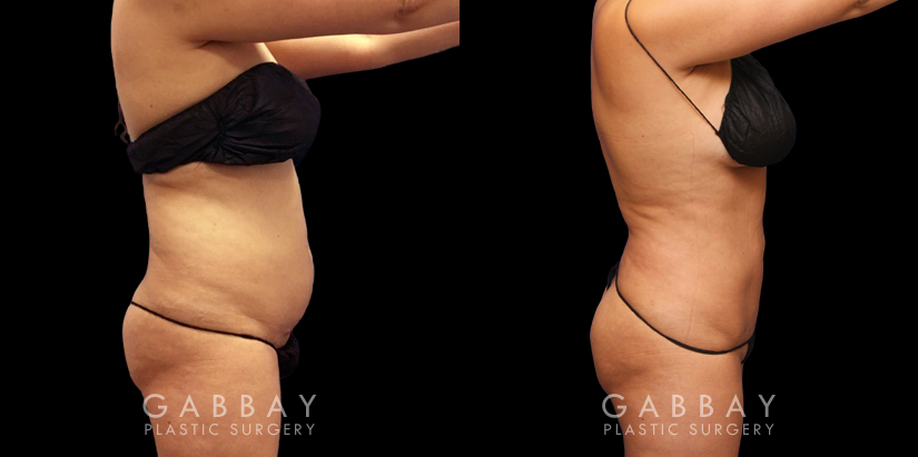 Abdominoplasty before and after photos post-recovery. Patient’s healing went smoothly, resulting in a firmer, tighter abdominal region, with a refined contour particularly visible in side profile.